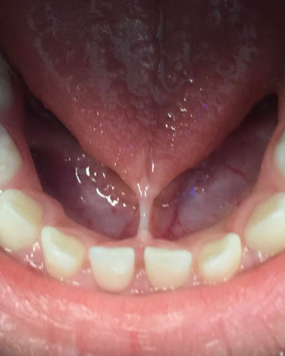 Example of a tongue tie